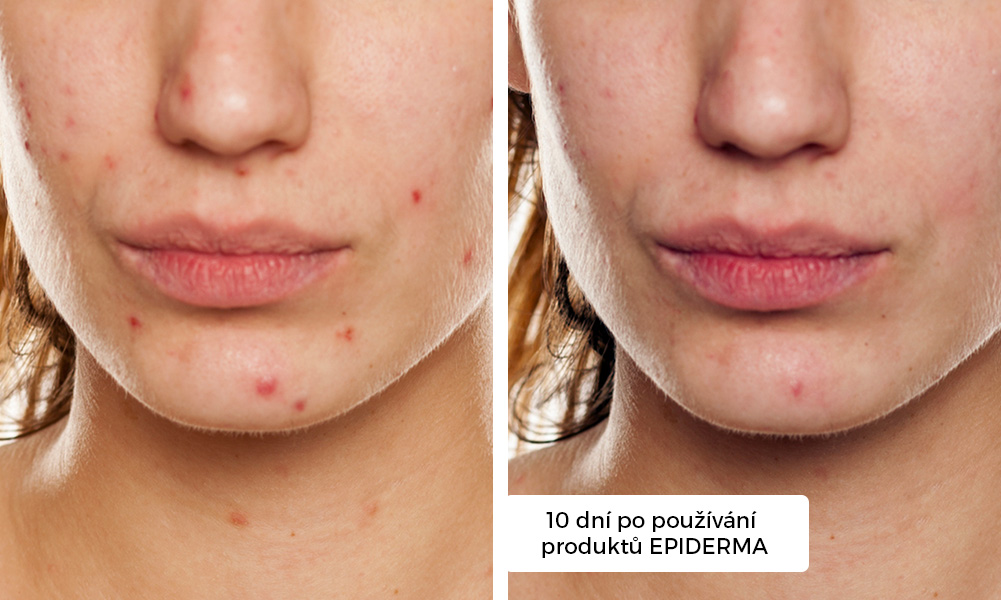 epiderma_pred a po